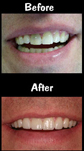 4 Porcelain Veneers