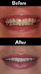 10 Porcelain Veneers