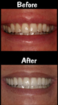 12 Porcelain Veneers