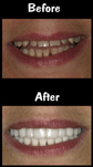 Full Mouth Reconstruction - 28 Porcelain Veneers & Crowns