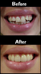 4 Porcelain Veneers