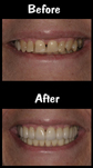 Full Mouth Reconstruction - Porcelain Veneers & Crowns & Bridge