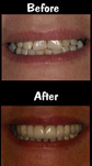 14 Porcelain Veneers