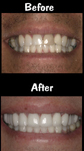 10 Porcelain Veneers