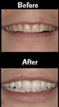Full Mouth Reconstruction - 28 Porcelain Veneers & Crowns