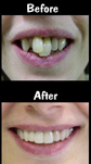 Porcelain Bridge & 2 Porcelain Veneers