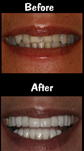 20 Porcelain Veneers & Crowns