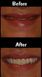 Full Mouth Reconstruction - 28 Porcelain Veneers & Crowns & Implants
