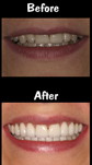 Full Mouth Reconstruction - 28 Porcelain Veneers & Crowns