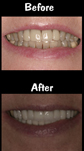 20 Porcelain Veneers & Crowns