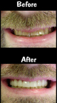 10 Porcelain Veneers