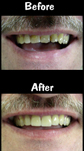 4 Porcelain Veneers