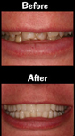 Full Mouth Reconstruction - 28 Porcelain Veneers & Crowns