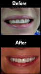 10 Porcelain Veneers