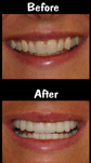 10 Porcelain Veneers