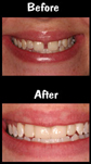 4 Porcelain Veneers
