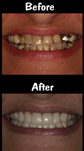 Full Mouth Reconstruction - Dental Implants & Porcelain Veneers & Crowns & Implant Supported Partial Dentures