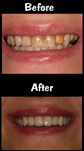Full Mouth Reconstruction - 28 Porcelain Veneers & Crown