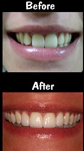 4 Porcelain Veneers