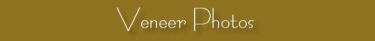 Veneer Photos