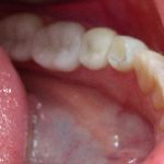 CEREC Porcelain Crowns After